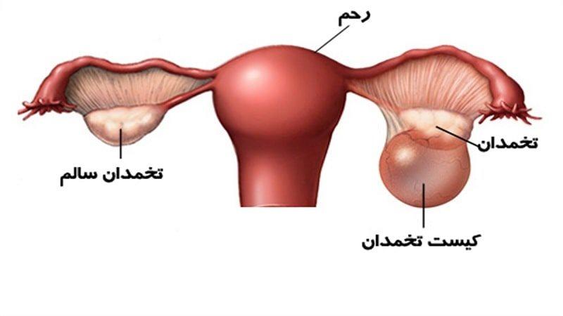 کیست واژن